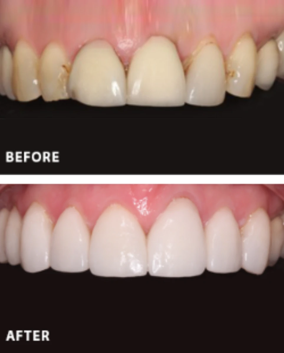 Smile Makeover